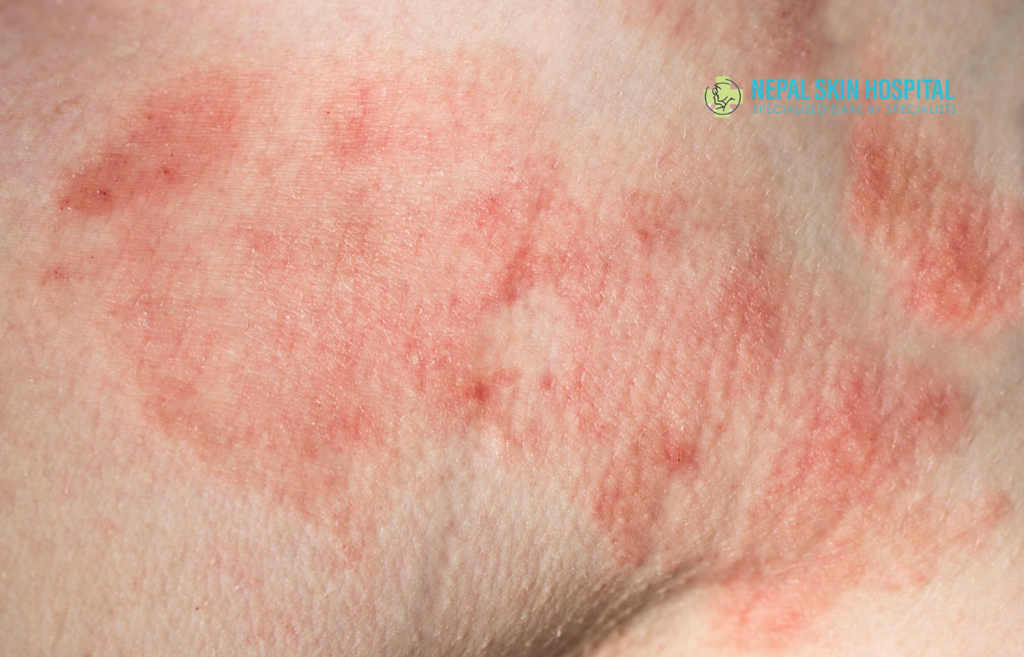 Fungal Skin Infection