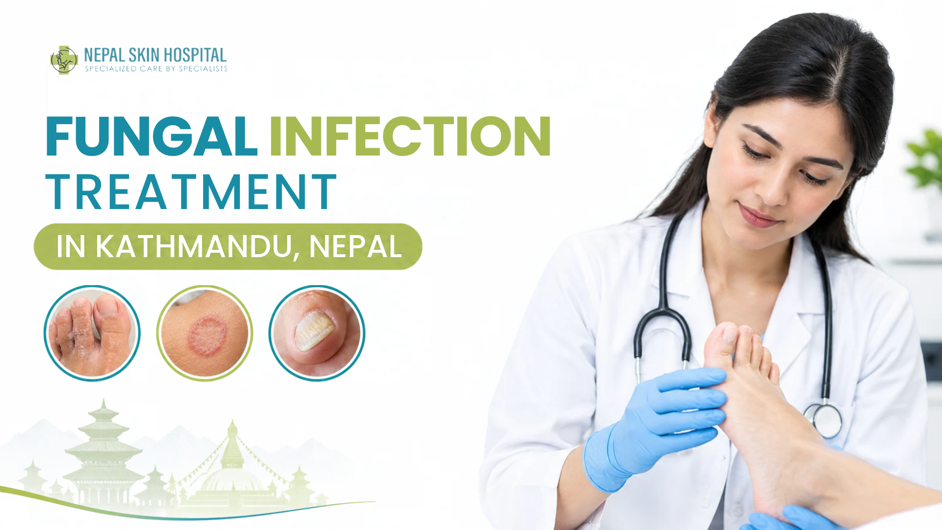 Fungal Infection Treatment in Nepal: Symptoms, Causes and When to See a Doctor