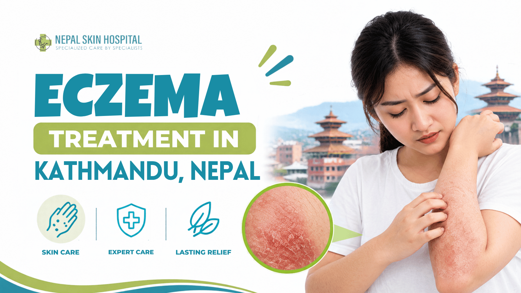 Eczema Treatment in Kathmandu, Nepal
